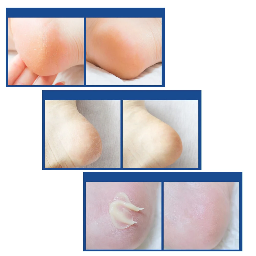 Medipeel+ EGF Scaling Moisture Foot Cream 2.0 , 130g — изображение 4